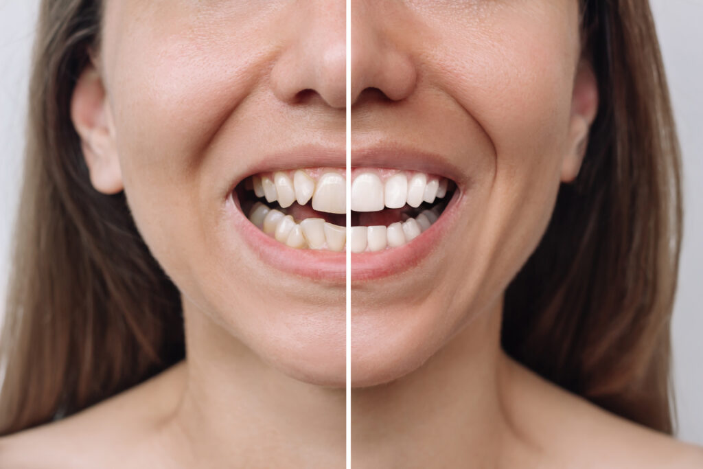 Cropped shot of a young caucasian woman before and after veneers installation. Teeth whitening. Dentistry, dental treatment. Сorrection of uneven teeth with braces. Comparison, difference