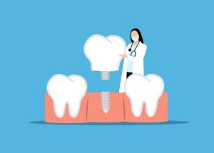 implant dentaire