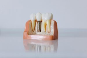 les avantages et précautions pour un implant dentaire pas cher