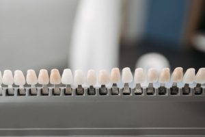 Facettes dentaires : tout savoir sur ce traitement